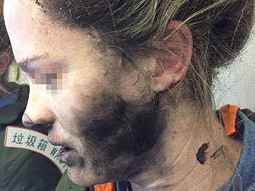 Вспыхнувшие наушники обожгли женщине лицо